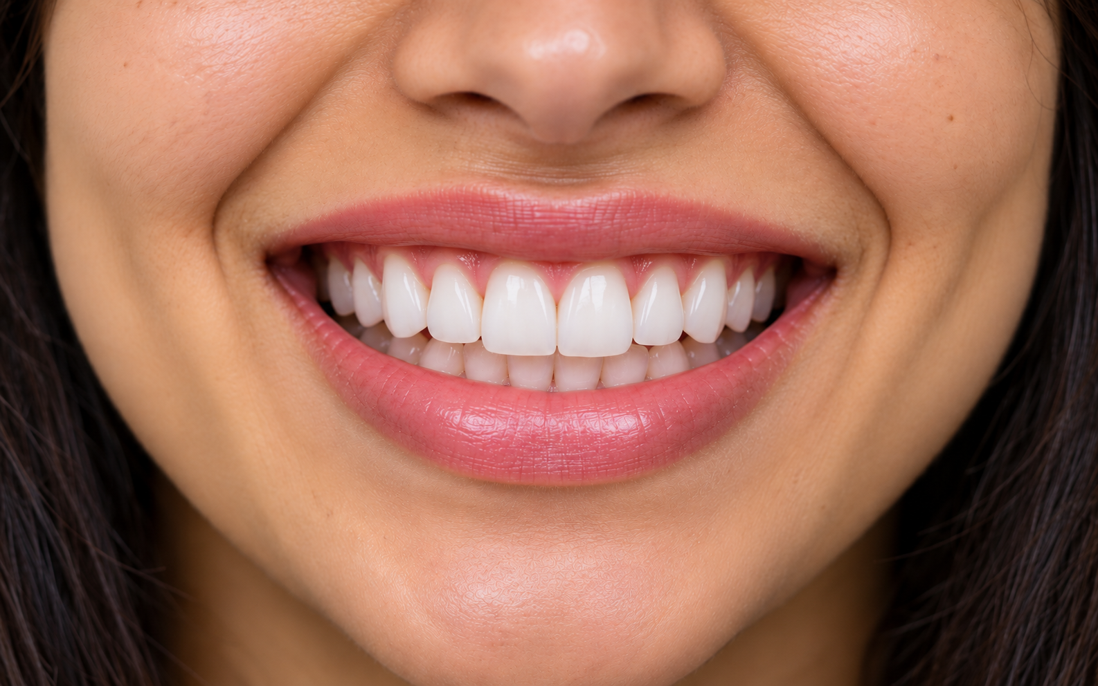Teeth after completion of cosmetic alignment and whitening