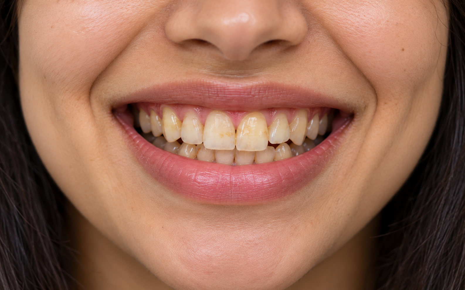 Upper and lower teeth prior to cosmetic alignment and whitening